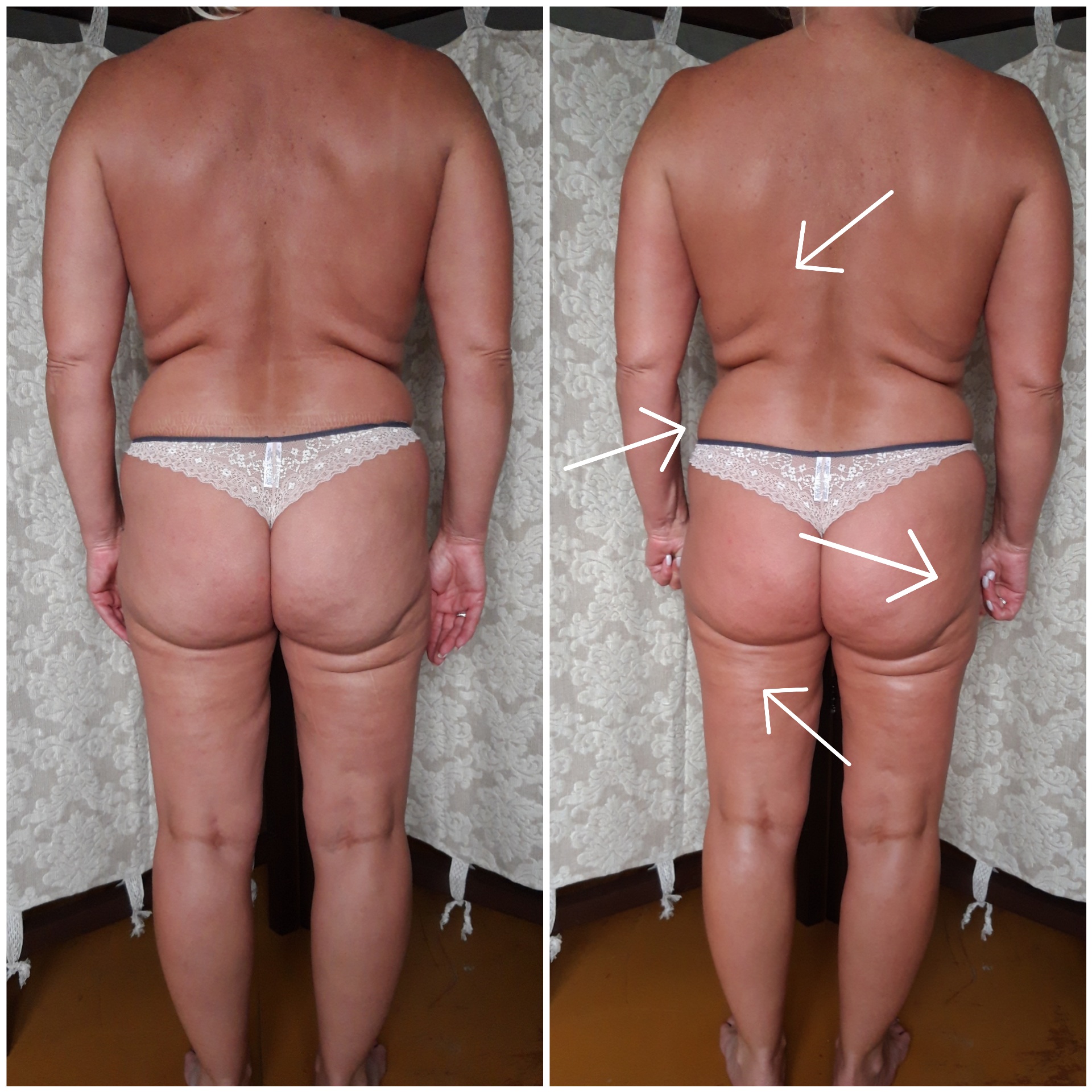 Terapia po liposukcji