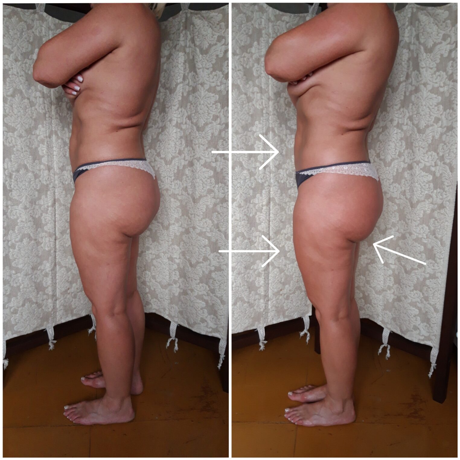 Jak działa Terapia po liposukcji?
